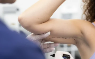 Renuvion: saiba tudo sobre esse tratamento para flacidez